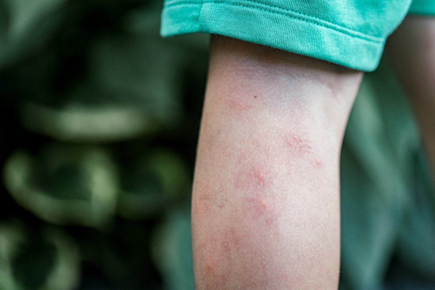 A close-up photo of the back of a child's leg, which is covered in mosquito bites. The child has light skin, which is marked by several red bites. The child is wearing green shorts, and a green plant can be seen blurred in the background. 